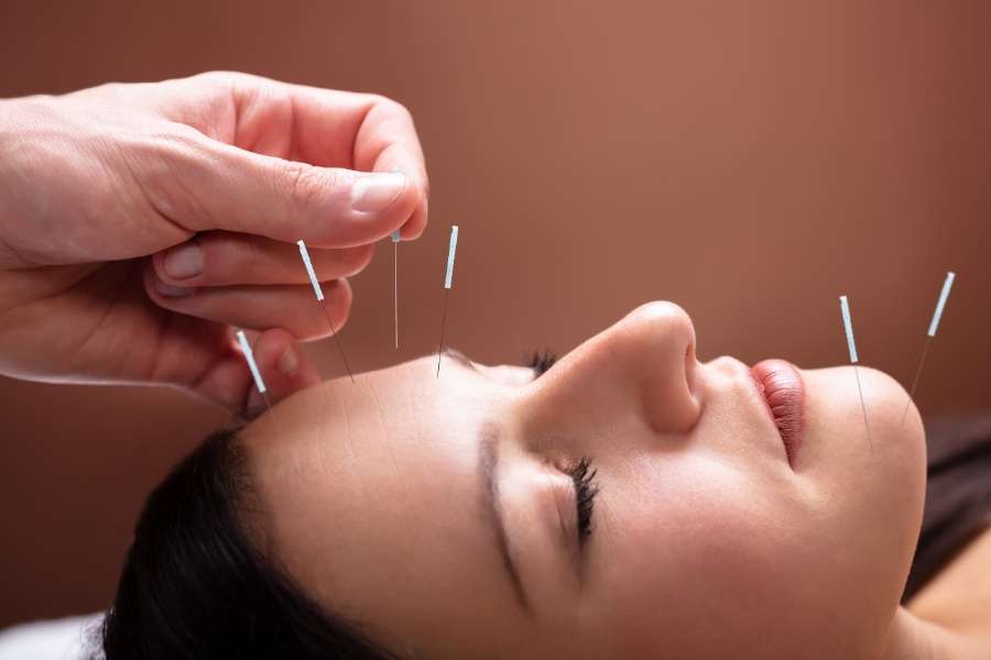 Un praticien pose de fines aiguilles d'acupuncture sur le visage et le front d'une femme détendue.